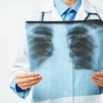 Symptoms of Lung Fibrosis