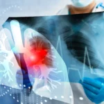 Lung Cancer Screening: What Every Smoker Should Know