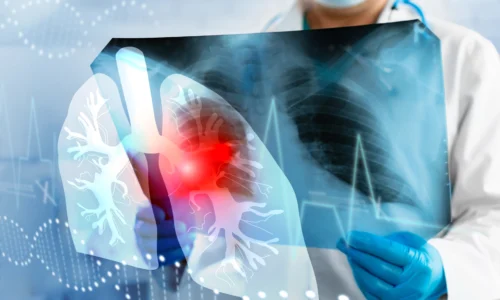 Lung Cancer Screening: What Every Smoker Should Know